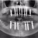 Mitos sobre los implantes dentales que son falsos