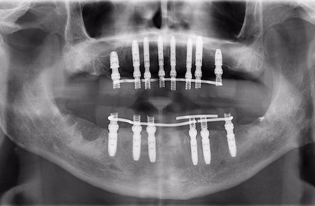Mitos sobre los implantes dentales que son falsos